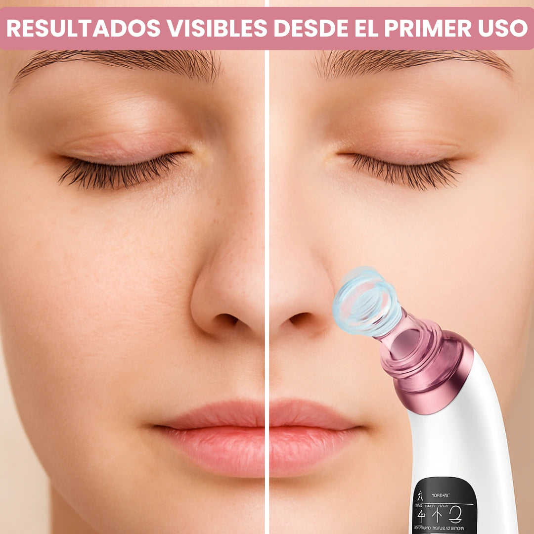 Extractor Eléctrico de Espinillas y Limpieza Facial Profesional + 4 Extractores Manuales